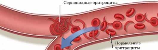 серповидная ретинопатия