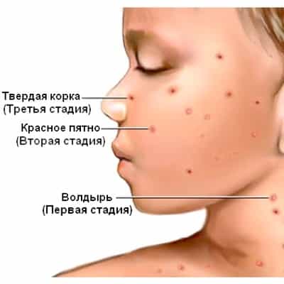 Как выглядят первые высыпания ветрянки Ветрянка: симптомы, заразность, лечение и профилактика ветряной оспы
